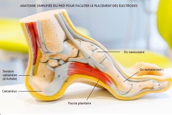 vue decoupee du pied pour placement des electrodes